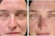 One or Three Sessions of TetraPRO or CoolPeel CO2 Fractional Laser on Choice of Treatment Areas (Up to 50% Off) - Second Medium