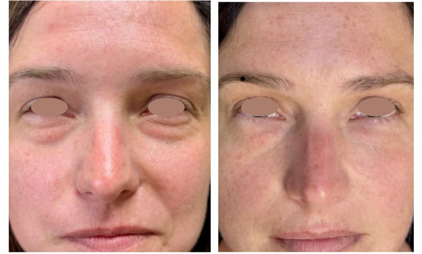 Image 4: One or Three Sessions of TetraPRO or CoolPeel CO2 Fractional Laser on Choice of Treatment Areas (Up to 50% Off)