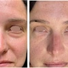 Image 4: One or Three Sessions of TetraPRO or CoolPeel CO2 Fractional Laser on Choice of Treatment Areas (Up to 50% Off)