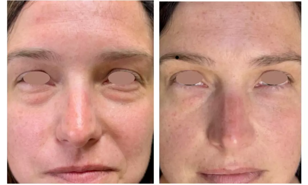 One or Three Sessions of TetraPRO or CoolPeel CO2 Fractional Laser