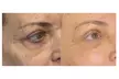 Up to 55% Off on Non Surgical Plasma Fibroblast SkinTightening Upper and Lower Eyelid Lift - Second Medium