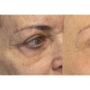 Image 2: Up to 55% Off on Non Surgical Plasma Fibroblast SkinTightening
