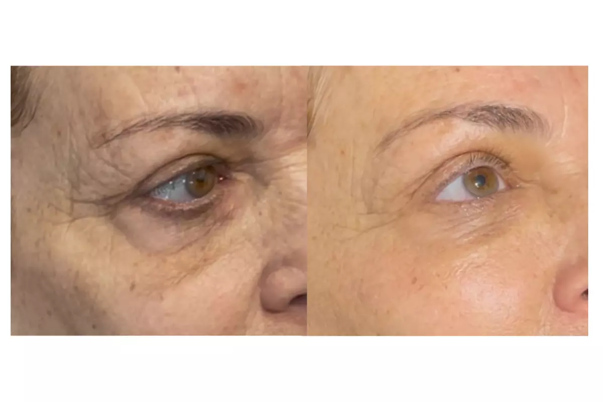 Up to 50% Off on Non Surgical Plasma Fibroblast SkinTightening