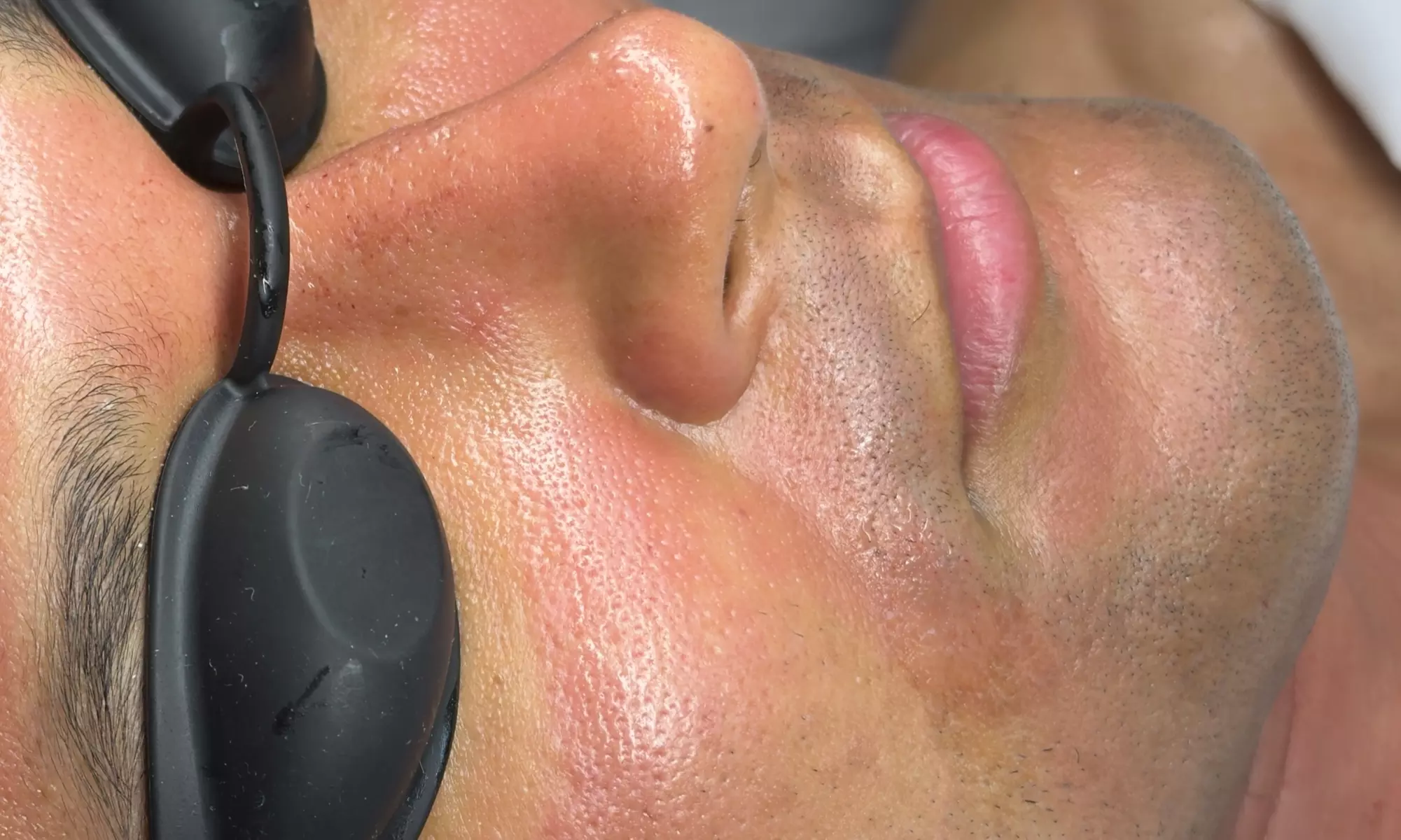 Luxury Exosome Mesotherapy with PDRN for Skin Repair & Radiance