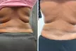Professional Laser Lipo Body Contouring Packages (5—15 Sessions) at Body and Aesthetics Houston (Up to 60% Off) - Second Medium