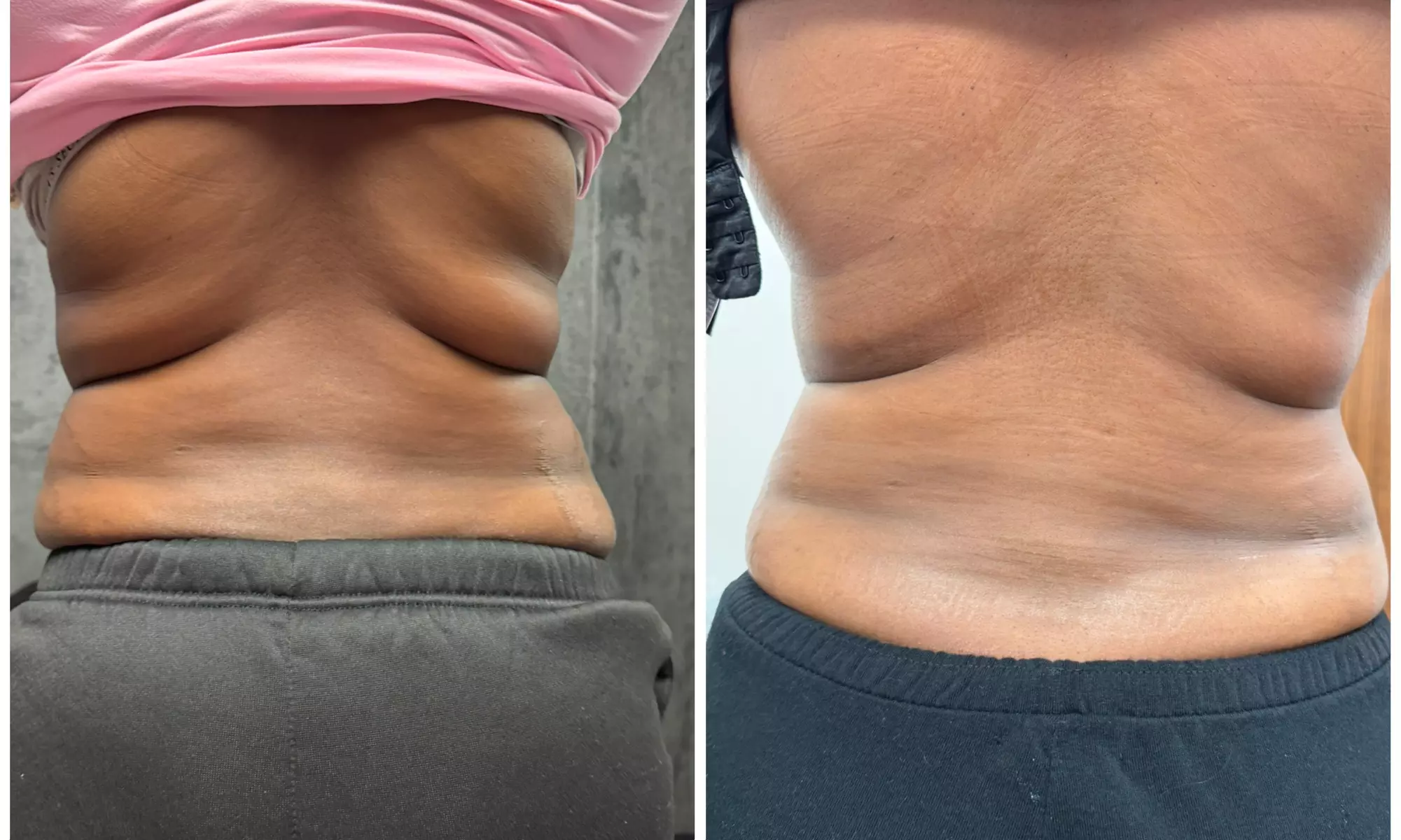 Professional Laser Lipo Body Contouring Packages (5—15 Sessions)