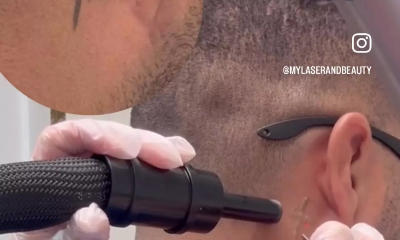 Up to 37% Off on Tattoo Removal at My Laser and Beauty