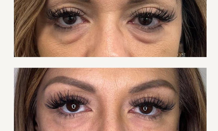 Image 7: One PRF Under Eye Treatment OR One PRF Full Face Rejuvenation