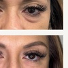 Image 7: One PRF Under Eye Treatment OR One PRF Full Face Rejuvenation