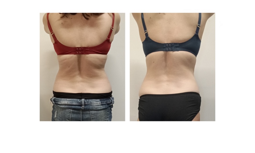 Image 4: Up to 58% Off on Fat Reduction - Non-Branded at Your Sculpt Studio