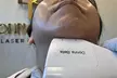 HIFU Non-Invasive Lifting, Skin Tightening of Skin, Jawline & Cheeks at Donna Bella Laser Medspa (Up to 40% Off) - Second Medium