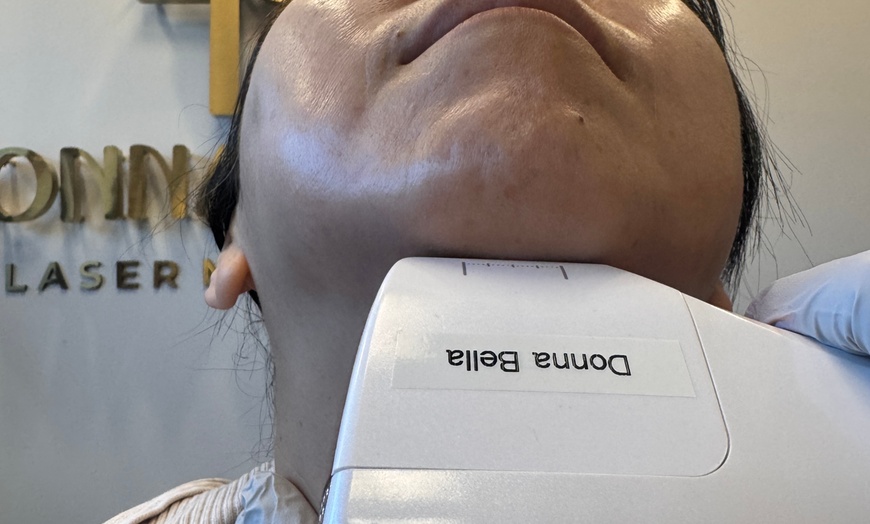 Image 2: HIFU Non-Invasive Lifting, Skin Tightening of Skin, Jawline and Cheeks