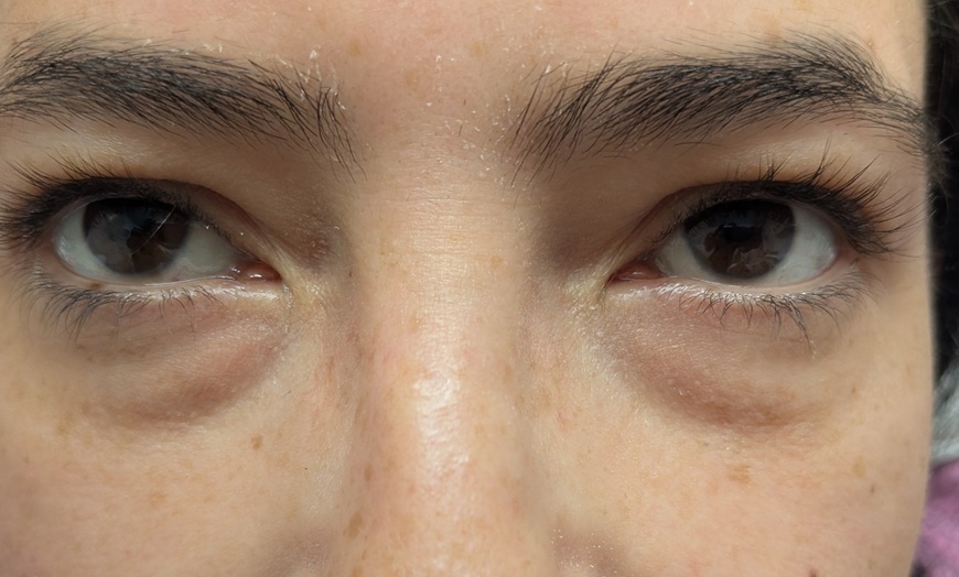 Image 1: Target Dark Circles & Puffiness: PRF Under-Eye Therapy (1/ 3 Sessions)