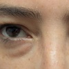 Image 1: Target Dark Circles & Puffiness: PRF Under-Eye Therapy (1/ 3 Sessions)