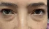 Up to 59% Off on Target Dark Circles & Puffiness: PRF Under-Eye Therapy (1/ 3 Sessions) at New life Cosmetic llc