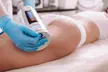 Up to 50% Off on Ultrasonic Fat Reduction at Lily & Rose Spa - Second Medium