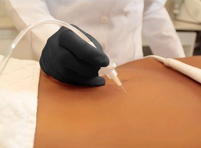 Carboxytherapy with Manual Drainage Session Included - Time for You Medical Spa