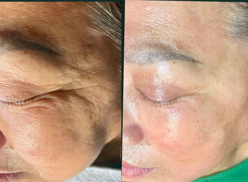 Up to 40% Off on HydraFacial at Regains Beauty & Aesthetics - Second Medium