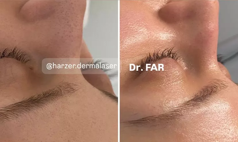 Premium Glow-Facial inkl. Wickeltherapie & MatrixxFace für 1 Person