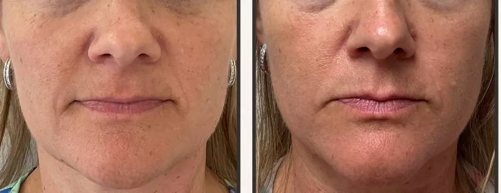 Up to 50% Off on Morpheus8 at Ziocorps Esthetique