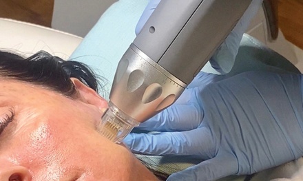 One RF Microneedling Treatment for Full Face - Revitamaxx