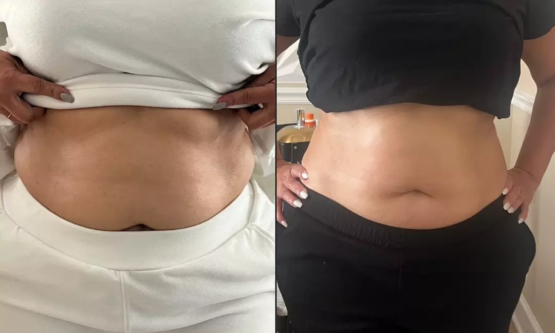 Up to 52% Off on Cavitation at Skin laboratory