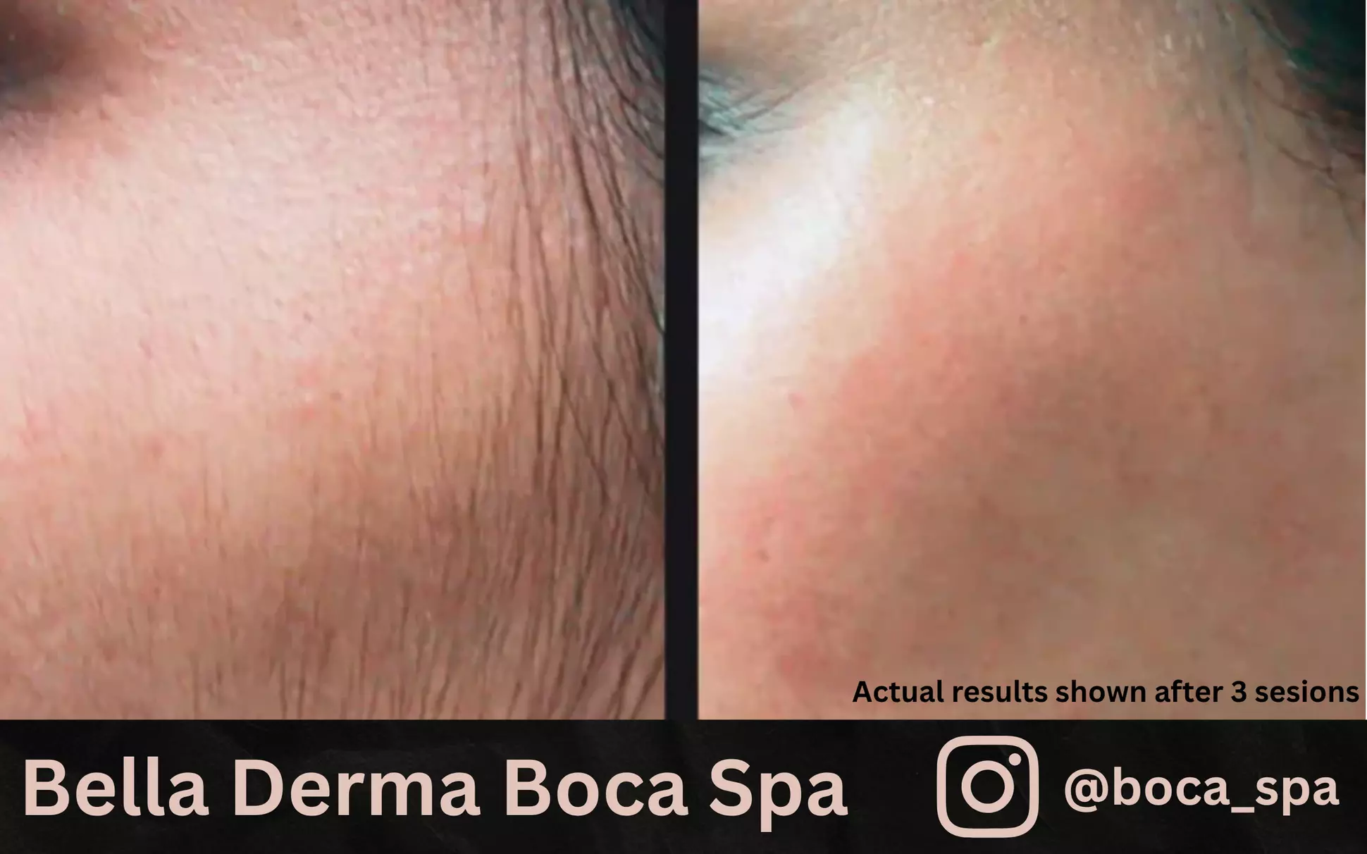 Experience The Ultimate Glow With Candela GentleMax Pro Laser Or HydroBeauty Facial Treatment at62% Off - Primary Image