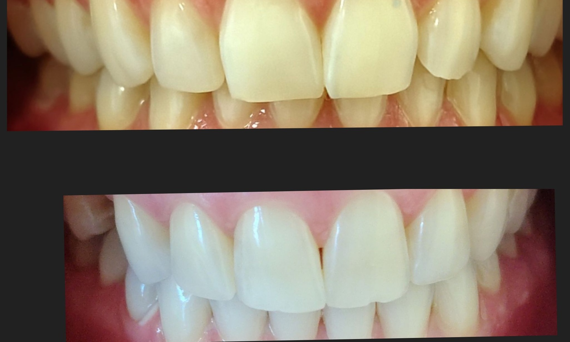 Teeth Whitening - In-Office - Pura Vida Esthetiques LLC