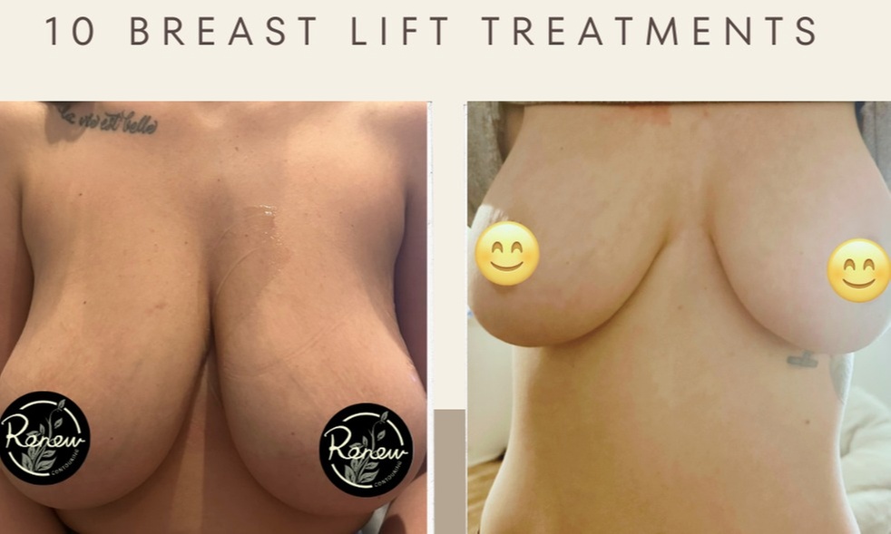 Revitalize with Non-Invasive Therma-Lift Breast Sessions