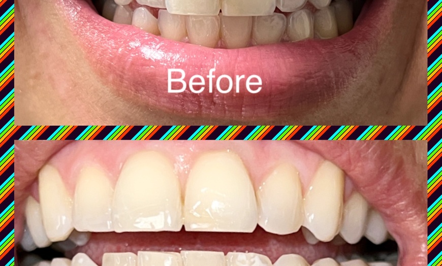 Image 4: Brighten Your Smile With Teeth Whitening, Polishing & More 