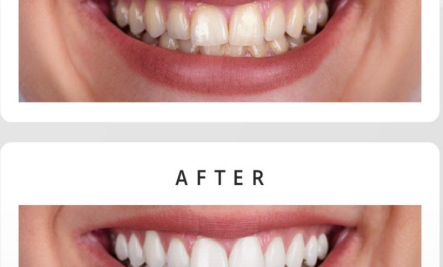 Image 3: Teeth Whitening Full Service Treatment 60-minute and More