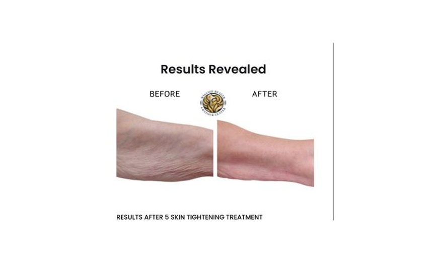 Image 5: One 30 Minutes or 1 Hour Venus Legacy Face or Body Sculpting Session