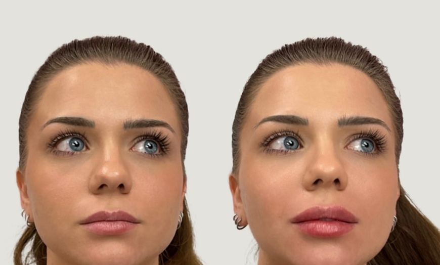Image 6: Up to 40% Off Dermal Filler at Hush Aesthetics, LLC
