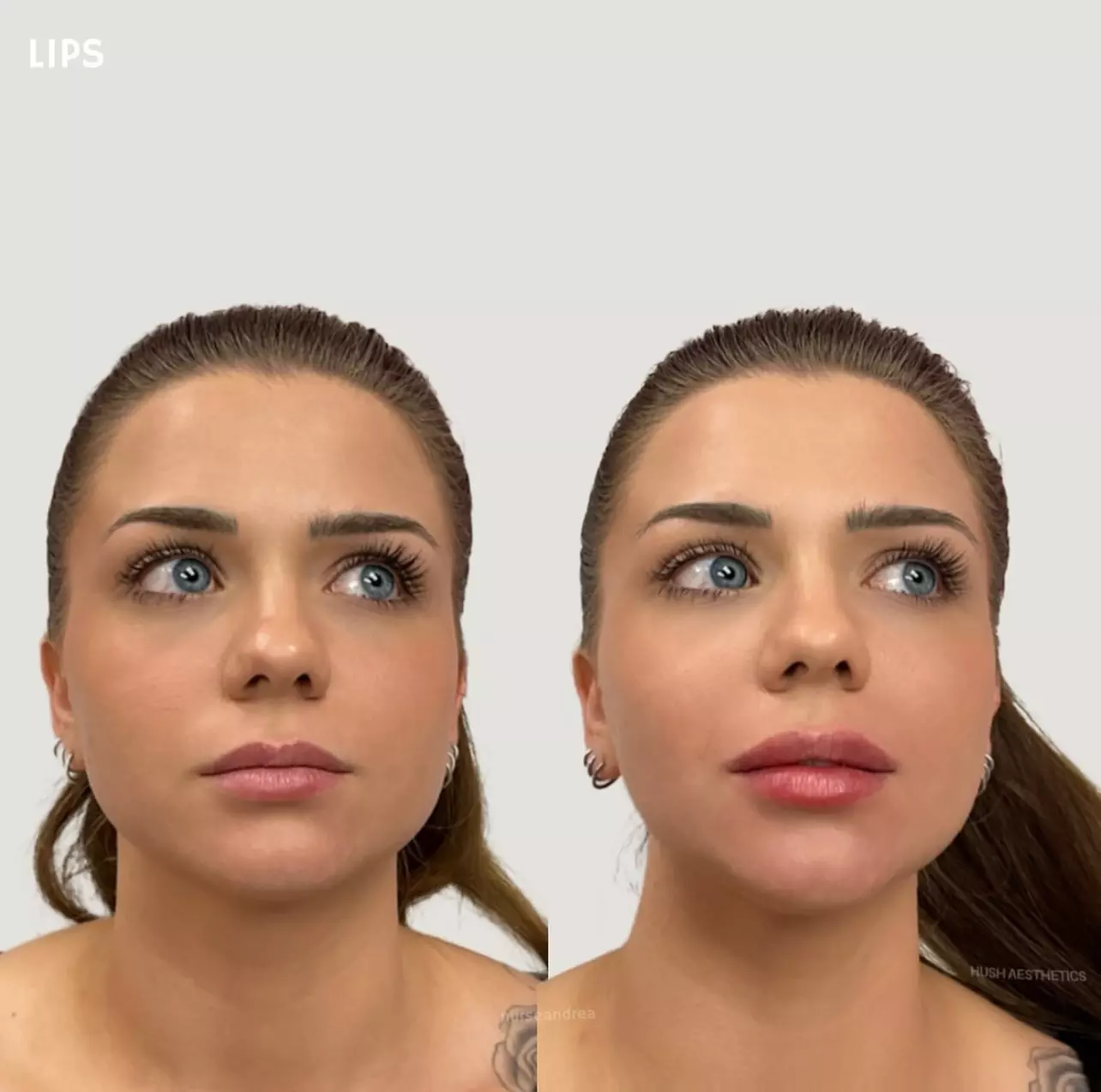 Up to 43% Off Dermal Filler at Hush Aesthetics, LLC