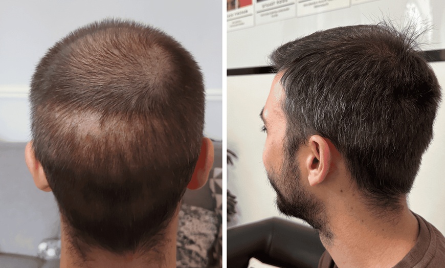Image 2: PRP hair care to support thicker and fuller looking hair
