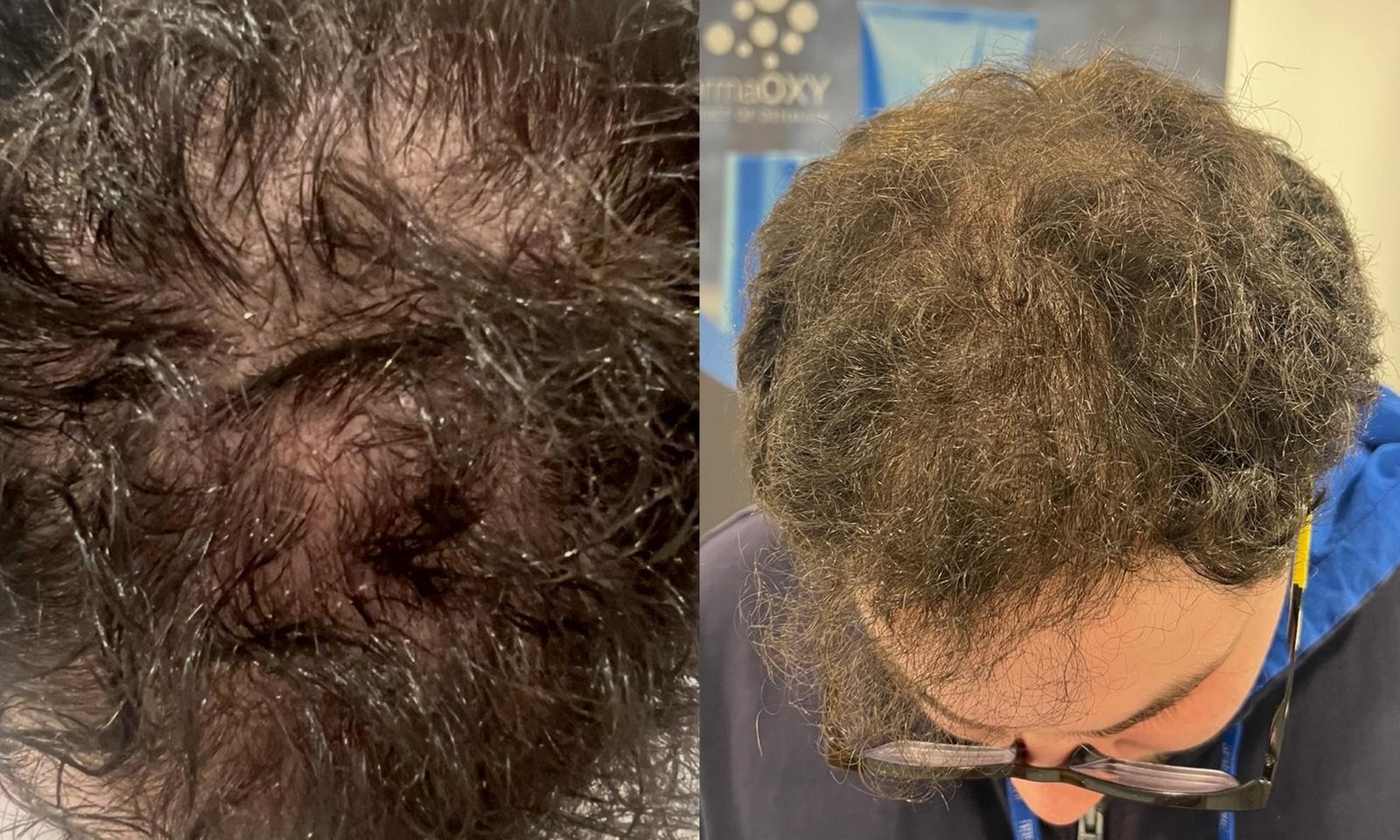 Oxygen Treatment and High Frequency Hair Restoration