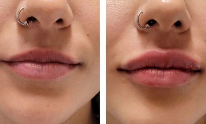 Image 1: Up to 30% Off on Injection - Dermal Filler at Soliz Healthcare Solutions