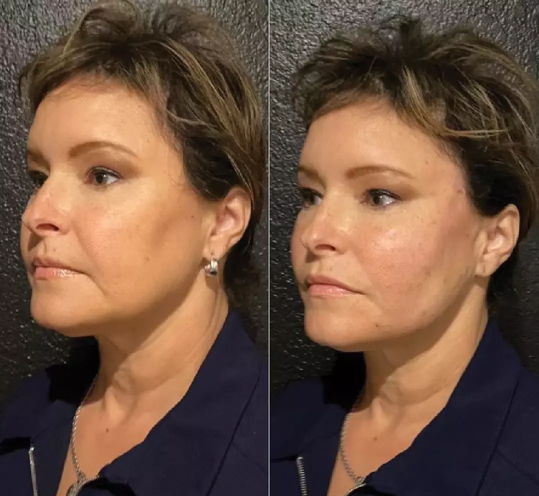 Smooth Wrinkles with 20, 40, or 60 Units of Xeomin