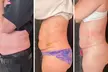 Up to 48% Off on Lipo - Non-Invasive Laser-iLipo at Extreme body sculpting - Second Medium