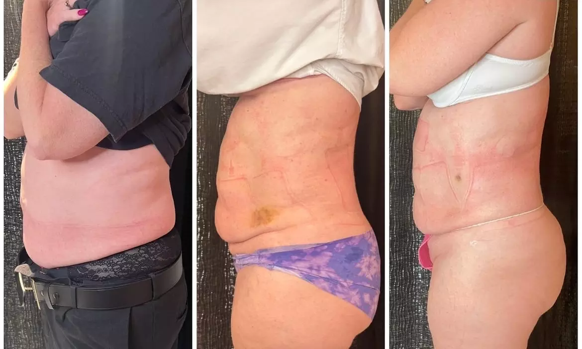 Up to 42% Off on Lipo - Non-Invasive Laser-iLipo at Extreme body sculpting