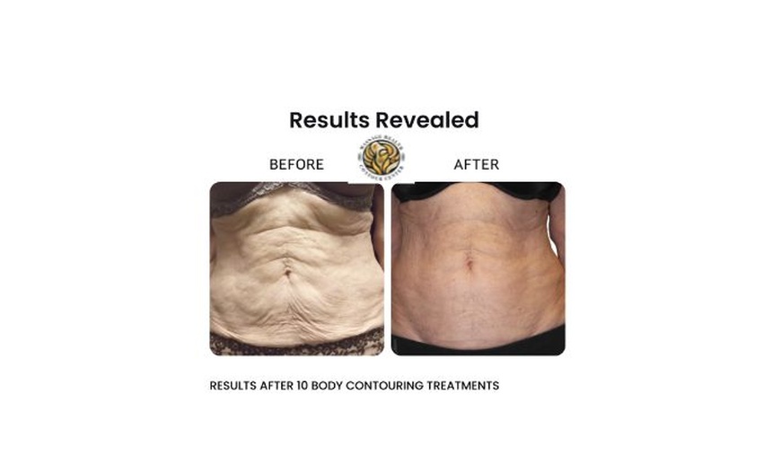 Image 4: One 30 Minutes or 1 Hour Venus Legacy Face or Body Sculpting Session