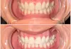 Teeth Whitening Treatment: 40-Minute for One or 45-Minute for Two at Smiles By Nilou - Up to 35% Off