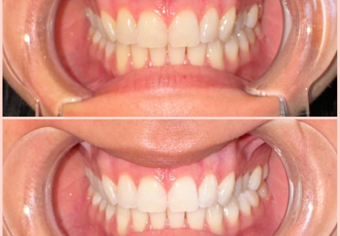 Teeth Whitening Treatment: 40-Minute for One or 45-Minute for Two