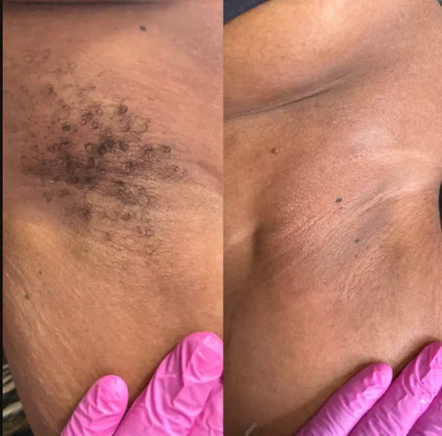 Wax Packages: One, Two. or Three Brazilian Wax or One Full Body Waxing