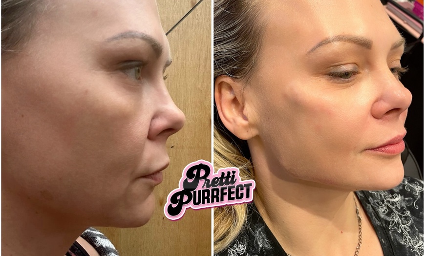 Image 10: Up to 68% Off on Injection - Dermal Filler at Pretti Purrfect