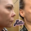 Image 10: Up to 68% Off on Injection - Dermal Filler at Pretti Purrfect