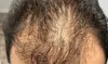 One Mesotherapy Session (Post-PRP Hair Restoration Treatment) at Serena Spa (Up to 52% Off)
