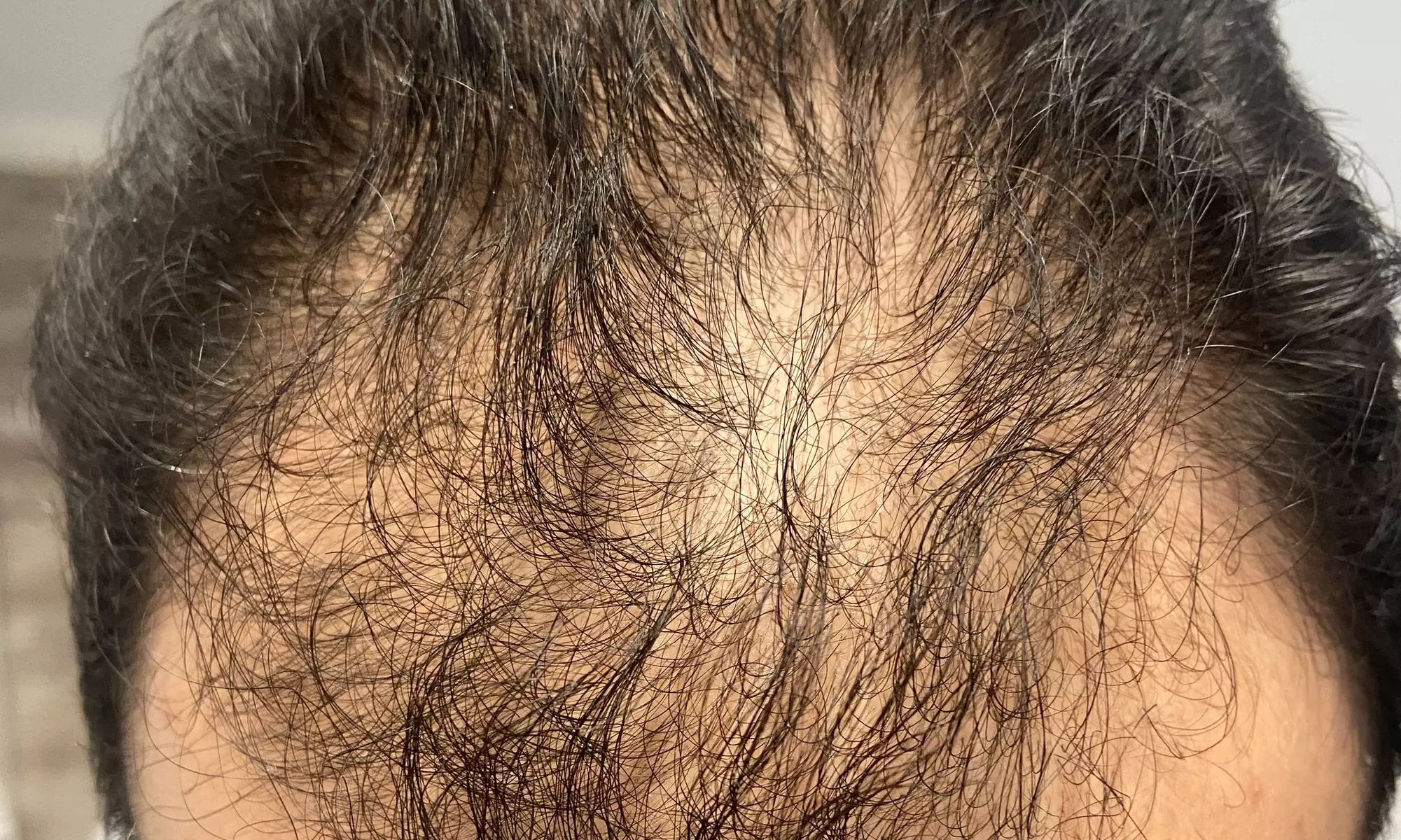 One Mesotherapy Session (Post-PRP Hair Restoration Treatment) at Serena Spa (Up to 52% Off) - Primary Image
