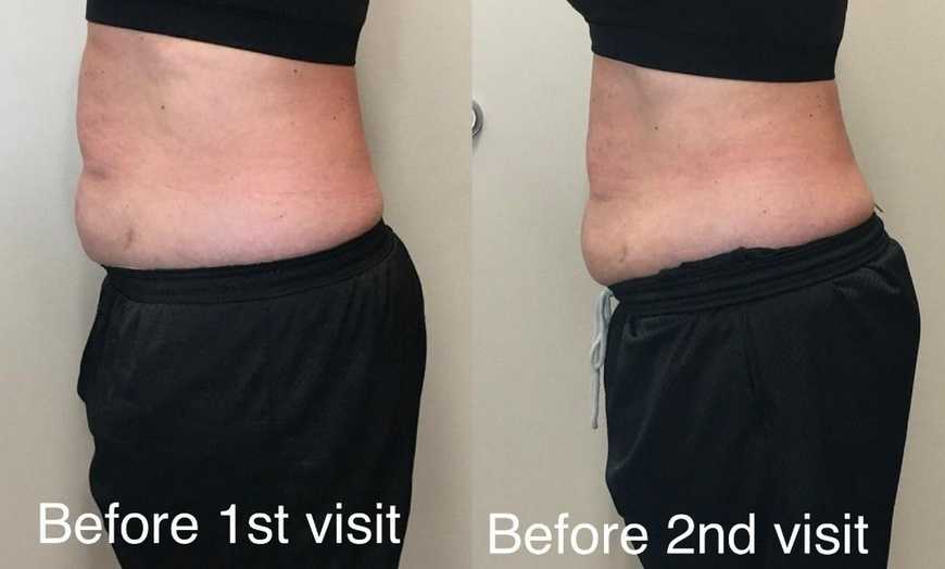 Image 3: Sculpt Your Dream Body with One Session of Cryo Sculpting