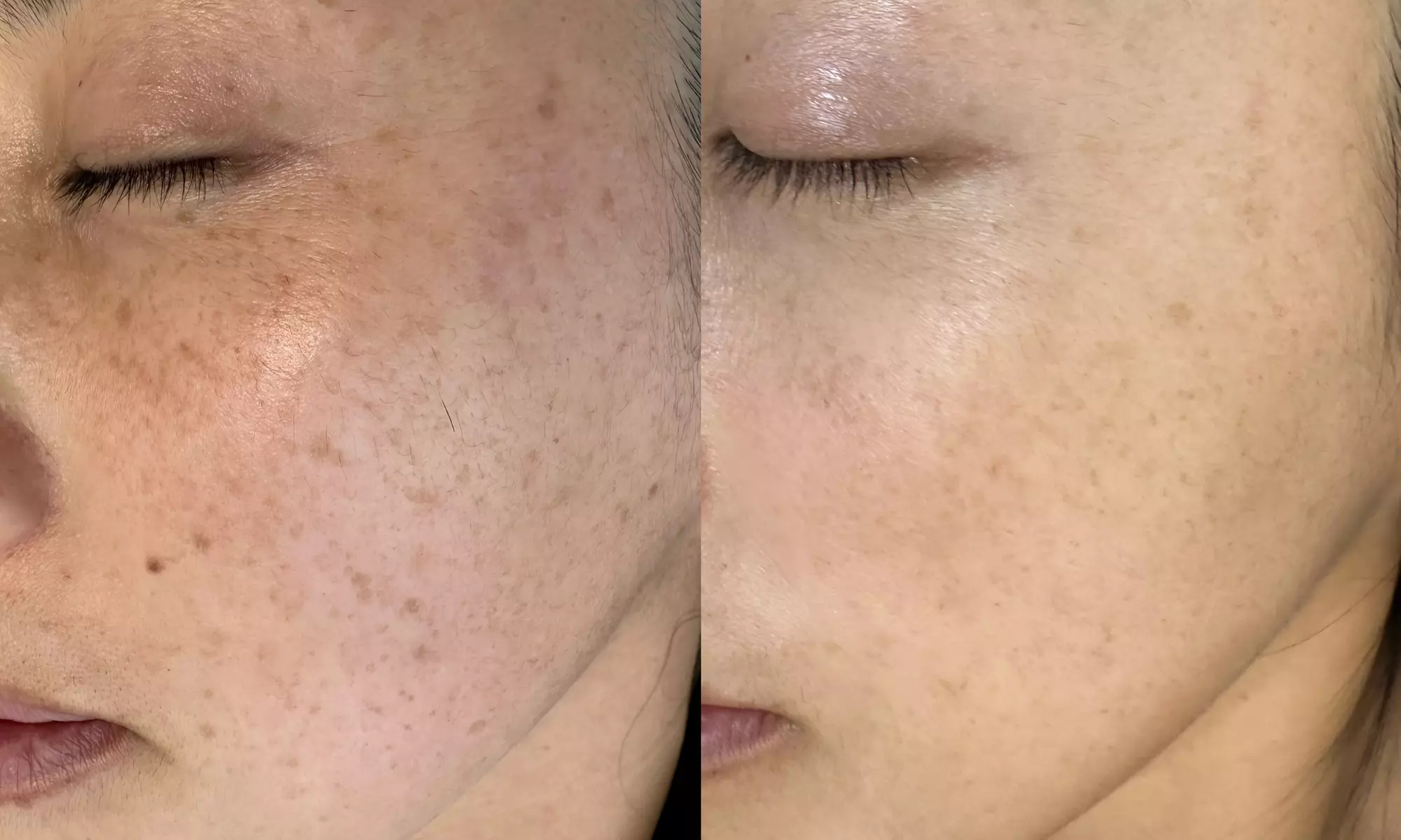 Pico Laser Sessions for Small Targeted Areas – 1 or 3 Options